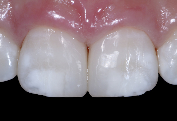 ダイレクトボンディングの前歯(すきっ歯)即日治療写真