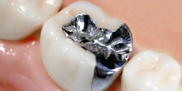 通常の虫歯治療