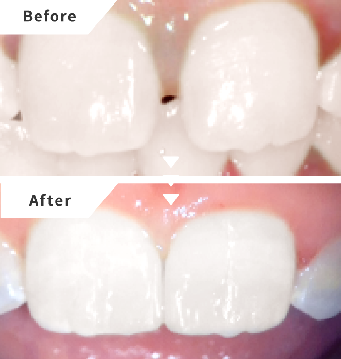 ダイレクトボンディングによる前歯(すきっ歯)の即日治療